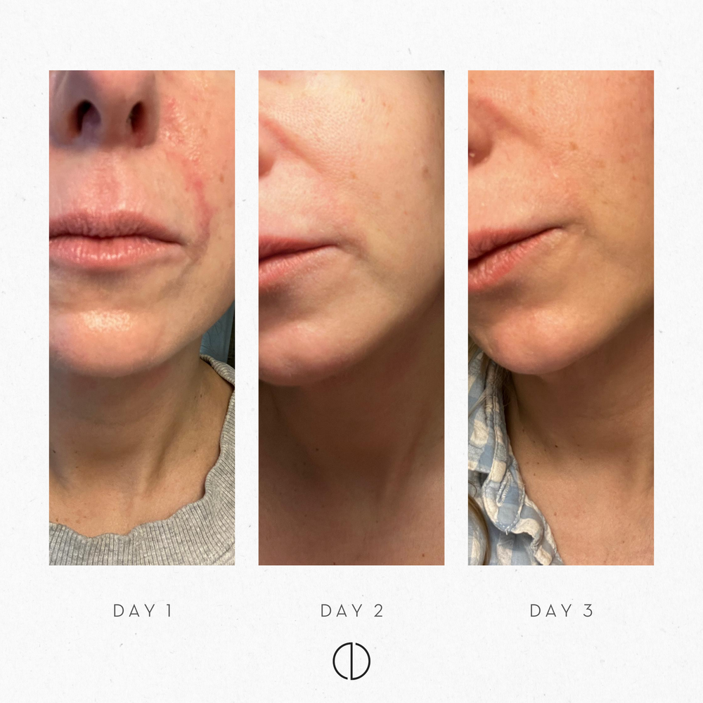 Johanna & POD in atopic skin