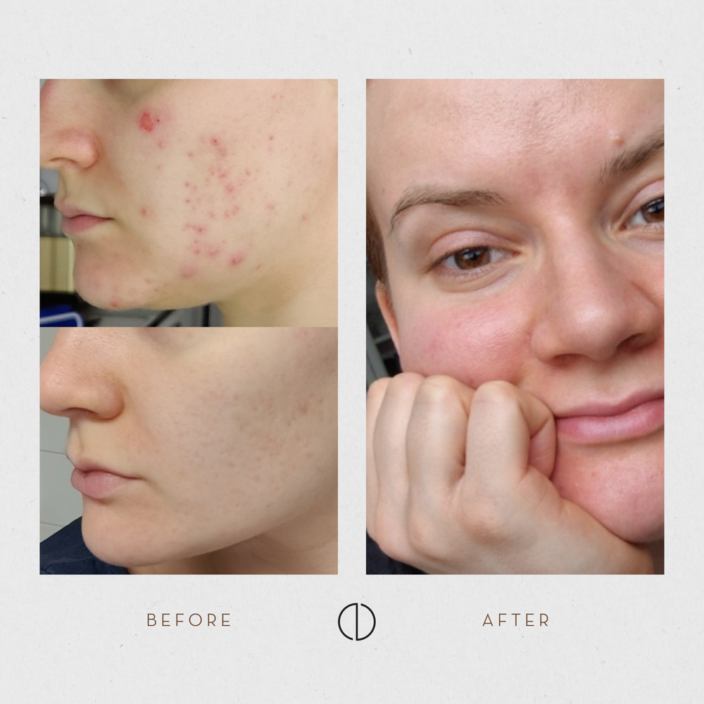 Iida's update on adult acne and 3 years of Laponie