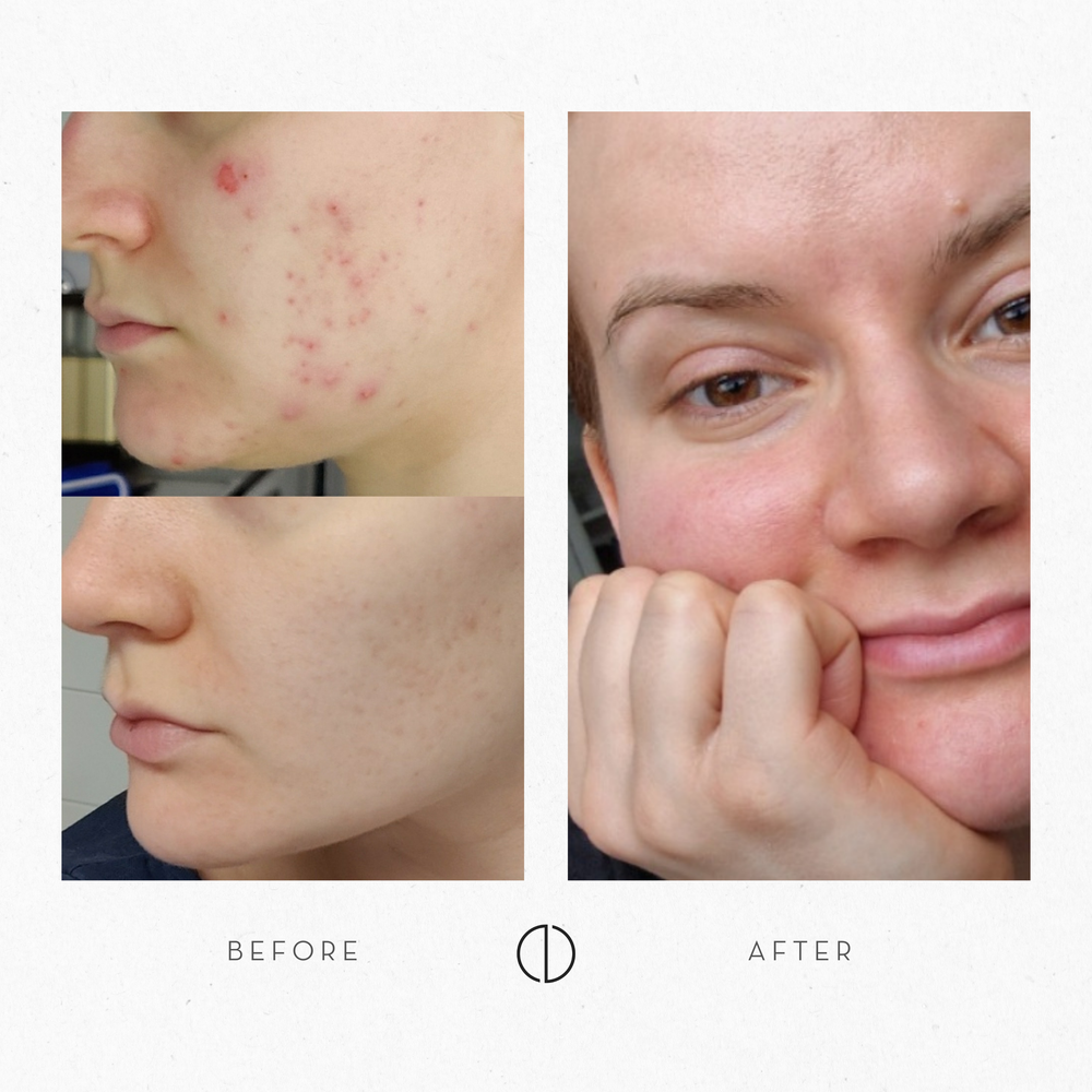Iida's update on adult acne and 3 years of Laponie