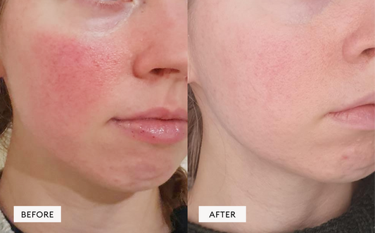Rosacea